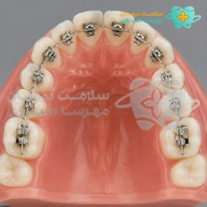 براکت ارتودنسی فلزی متصل به مدل دندان به همراه سیم آرچ وایر